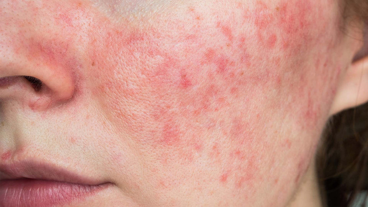 5 remedios naturales para ayudar a tratar la rosácea